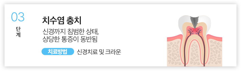 03.치수염 충치