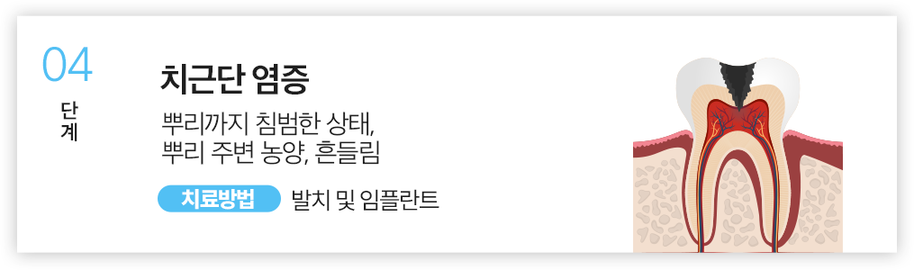 04.치근단 염증