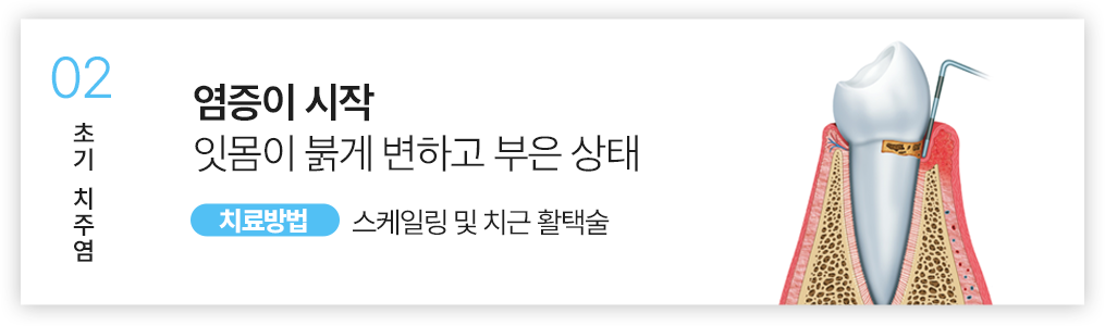 02.염증이 시작 잇몸이 붉게 변하고 부은 상태