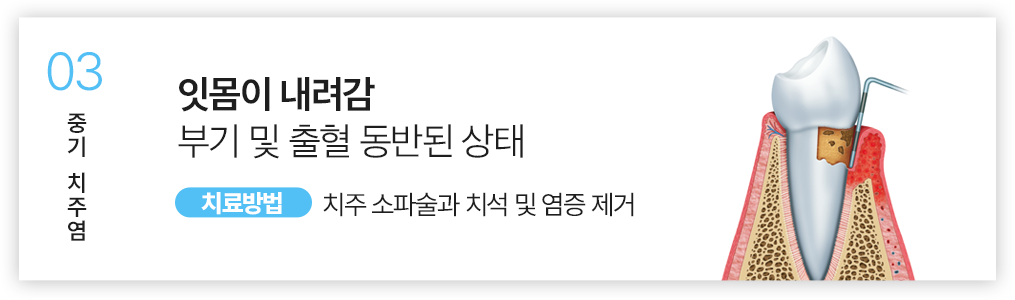 03.잇몸이 내려감 부기 및 출혈 동반된 상태