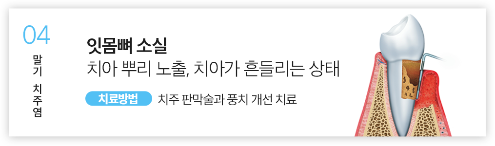 04.잇몸뼈 소실 치아 뿌리 노출, 치아가 흔들리는 상태